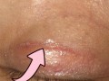双眼皮手术后的疤痕问题，了解风险与预防措施