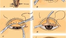 双眼皮手术对身体的影响，利弊分析