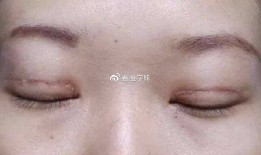 双眼皮手术后会不会留疤，全面解析术后恢复与疤痕预防