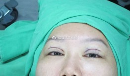 双眼皮手术后的可能后果与注意事项