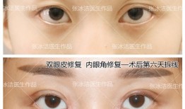 双眼皮手术，了解可能的副作用与风险
