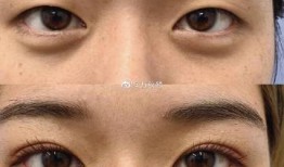 双眼皮手术与财运，迷信与现实的碰撞