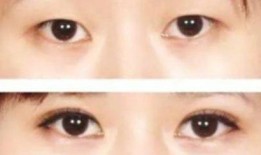 双眼皮手术后的潜在后遗症及其预防措施