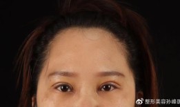 双眼皮手术后对怀孕的影响，科学解析与专业建议