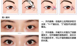 双眼皮手术后遗症，全面解析与视频指南