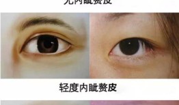 双眼皮手术的风险与安全指南