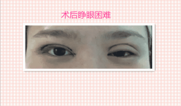 双眼皮手术后遗症，全面解析与视频指南