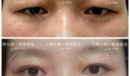 双眼皮手术的风险与安全指南