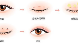 双眼皮手术后对怀孕的影响，科学解析与专业建议