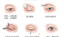 双眼皮手术的潜在后遗症及其预防措施