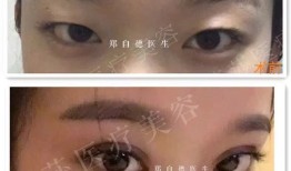 双眼皮手术后的潜在后遗症及其应对策略