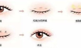 双眼皮手术后的可能后果与注意事项