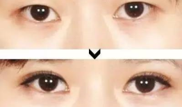 双眼皮手术的后遗症及其预防措施