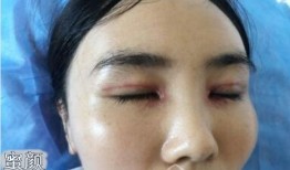 双眼皮手术后会不会留疤，全面解析术后恢复与疤痕预防