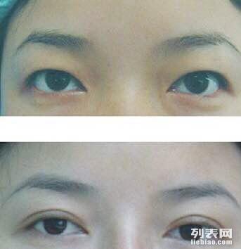 双眼皮手术的长期影响，美丽与风险的权衡