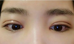 双眼皮手术后的后遗症，了解可能的风险与预防措施