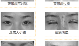 双眼皮手术后的后遗症，了解风险与预防措施