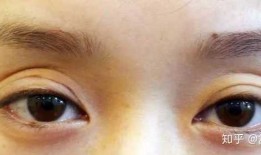 双眼皮手术后的后遗症，了解可能的风险与预防措施