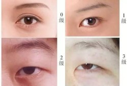 双眼皮手术后的后遗症，了解风险与预防措施