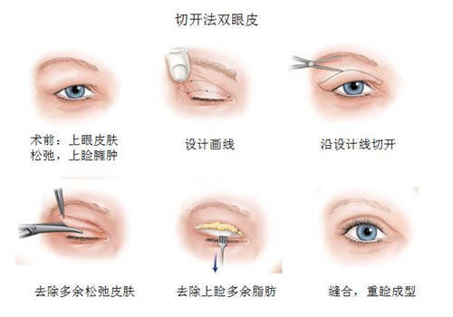 双眼皮手术的潜在后遗症及其预防措施