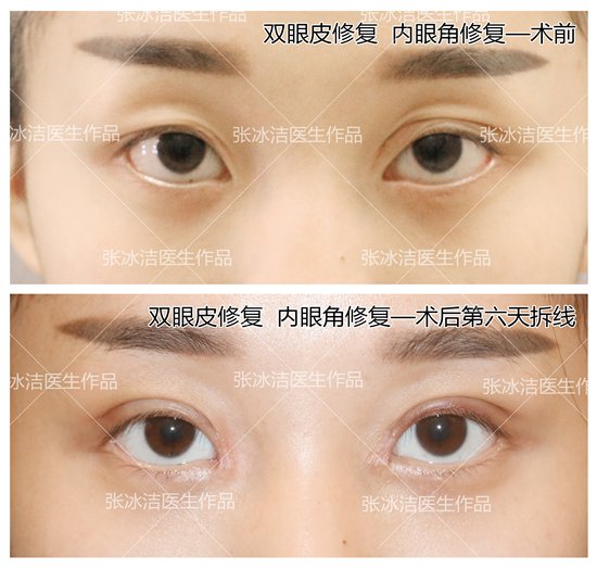 双眼皮手术，了解可能的副作用与风险