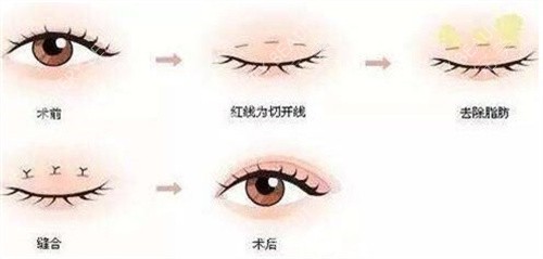 做双眼皮手术，后果、风险与恢复过程